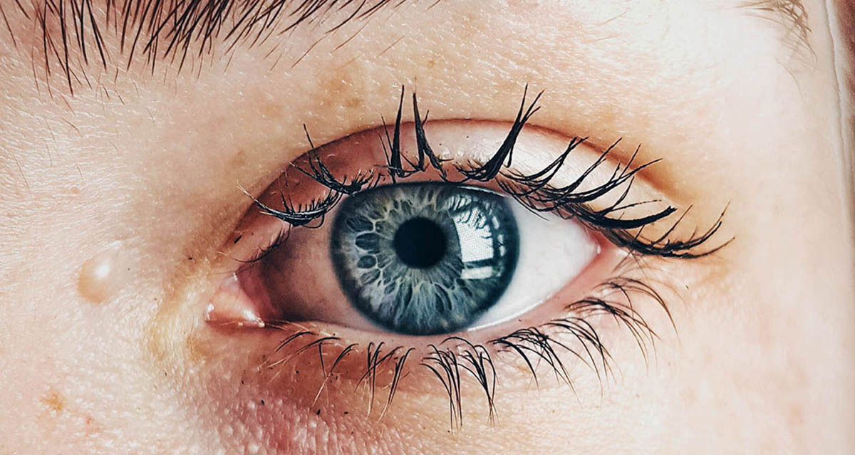 Leber congenital amaurosis (LCA) and earlyonset severe retinal dystrophy (EOSRD) CERA