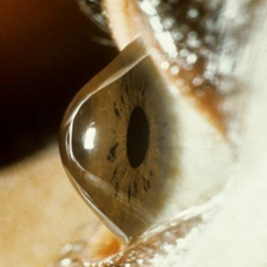 keratoconus eye