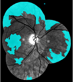 Image of blue retinal grading